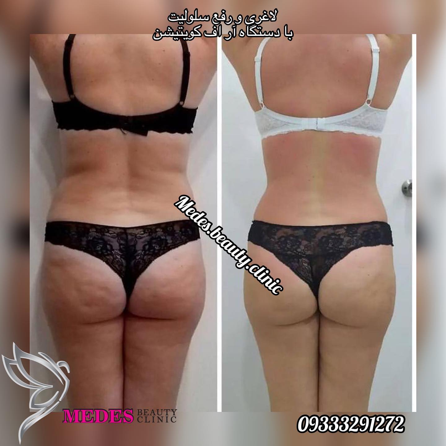 گالری لاغری با دستگاه